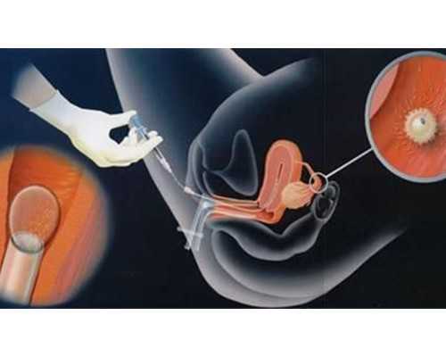 试管基础卵泡少促排能增加数量吗？质量比数量更重要